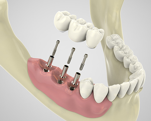 Implant dentaire Dentiste-chaumes-en-retz